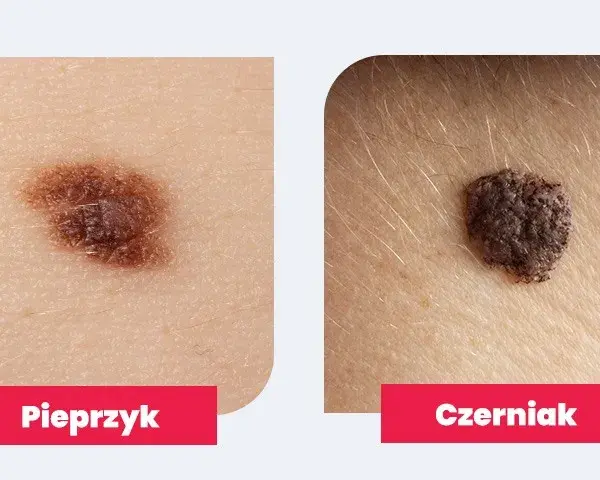 Dlaczego pieprzyk boli jak pryszcz? Objawy, które mogą niepokoić