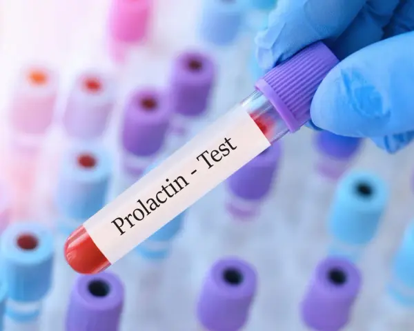Ręka w niebieskiej rękawiczce trzyma probówkę z napisem "Prolactin - Test". Kiedy badać prolaktynę? To pytanie często zadawane przez pacjentów.