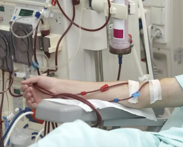 Ramię pacjenta podłączone do maszyny do dializy. Czerwone wężyki prowadzą krew do aparatu, który oczyszcza ją podczas dializy.