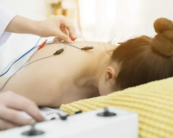 Elektroakupunktura: igły z elektrodami na plecach pacjentki. Choć metoda ta ma wiele zalet, warto pamiętać o potencjalnych skutkach ubocznych.