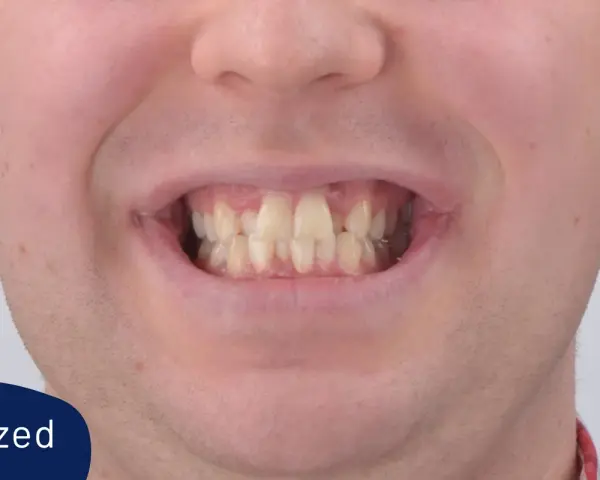 Uśmiech przed leczeniem aparatem Invisalign. Widoczne nierówne i lekko pożółkłe zęby.
