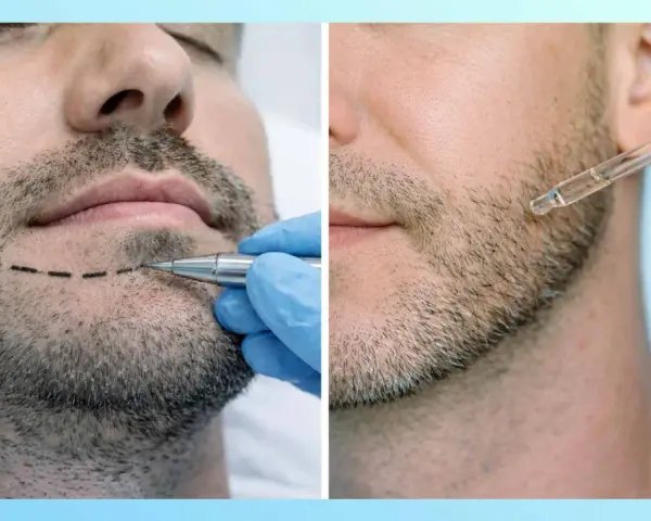 Doble imagen: un hombre con línea marcada en la barba y un aplicador, y otro hombre recibiendo gotas de minoxidil.