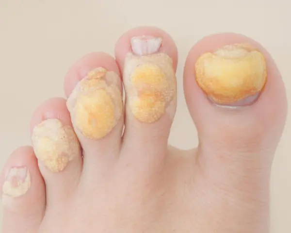 Pieds avec plusieurs pansements pour l'extraction de cors.