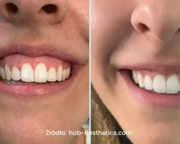 Uśmiech z widocznymi zębami i dziąsłami, porównanie przed i po zabiegu. Zniknął problem gummy smile.