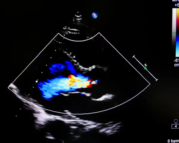 Obraz USG serca z kolorowym Dopplerem, pokazujący przepływ krwi. Może być pomocny w diagnostyce przewlekłej niewydolności żylnej.