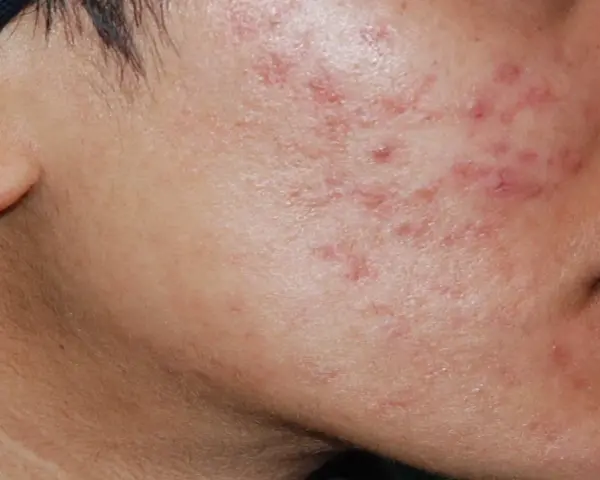 Primo piano del viso di una persona con evidenti cicatrici da acne sul lato destro della guancia e sul mento.