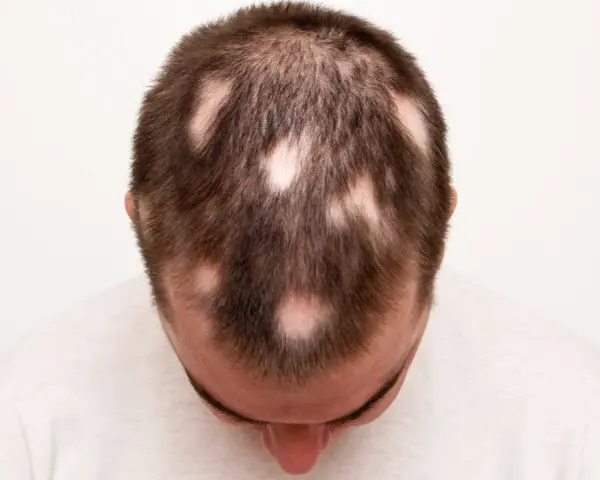Calvizie a chiazze sulla testa di un uomo, sintomo di alopecia da stress.