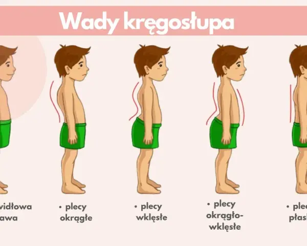 Ilustracja pokazuje wady kręgosłupa: plecy okrągłe, wklęsłe, okrągło-wklęsłe i płaskie, obok prawidłowej postawy.