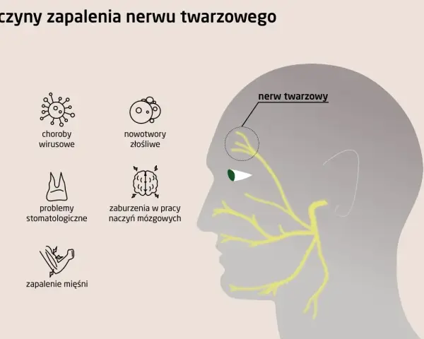 Ilustracja przedstawia przyczyny zapalenia nerwu twarzowego, w tym neuralgia nerwu trójdzielnego, choroby wirusowe, nowotwory, problemy stomatologiczne, zaburzenia naczyń mózgowych i zapalenie mięśni.