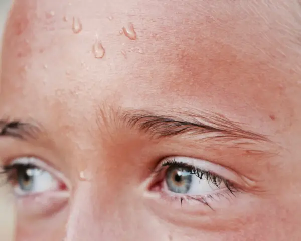 Gotas de sudor en la frente de una persona, un síntoma común de hiperhidrosis facial.