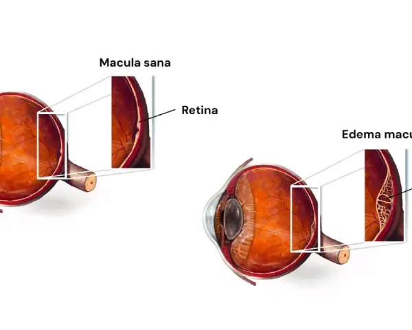 Confronto tra occhio sano e occhio con edema maculare. L'edema maculare si riassorbe, mostrando la retina gonfia e piena di liquido.