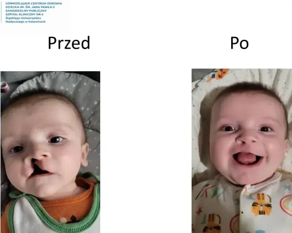 Uśmiechnięte dziecko po korekcie rozszczepu wargi. Wcześniej widoczna była zajęcza warga.