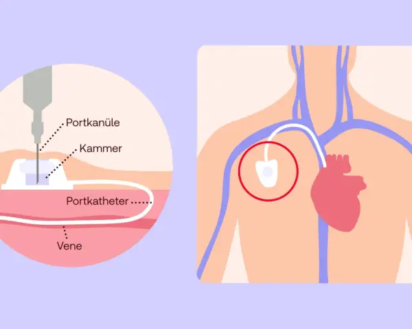 Illustration zeigt eine Portkanüle, die in eine Vene eingeführt wird, um Chemotherapie zu verabreichen.