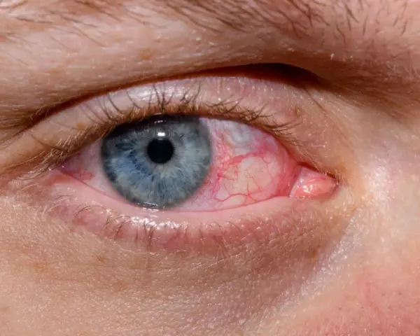 Occhio azzurro con congiuntiva arrossata e vasi sanguigni evidenti. Esistono gli occhi rossi, un segno di irritazione o infezione.