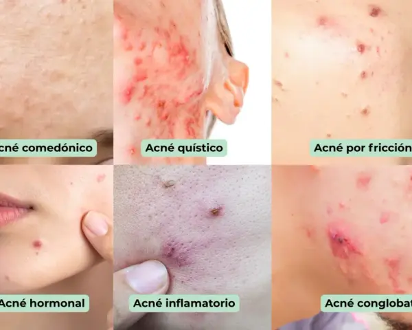 Seis tipos de acné: comedónico, quístico, por fricción, hormonal, inflamatorio y   conglobata.