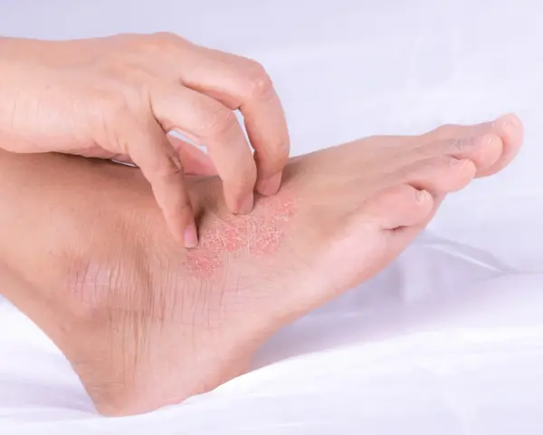 Una mano se rasca la piel escamosa y enrojecida de un pie, mostrando los efectos de la psoriasis en los pies.
