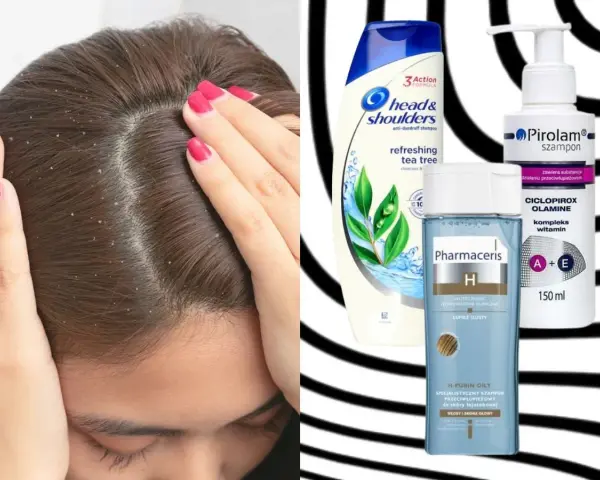 Widok głowy z łupieżem i szampony: Head & Shoulders, Pirolam, Pharmaceris. Co na łupież? Te produkty mogą pomóc.