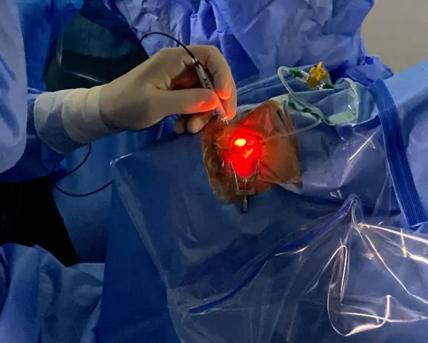 Un chirurgo esegue una vitrectomia, un intervento per rimuovere il corpo vitreo dall'occhio.