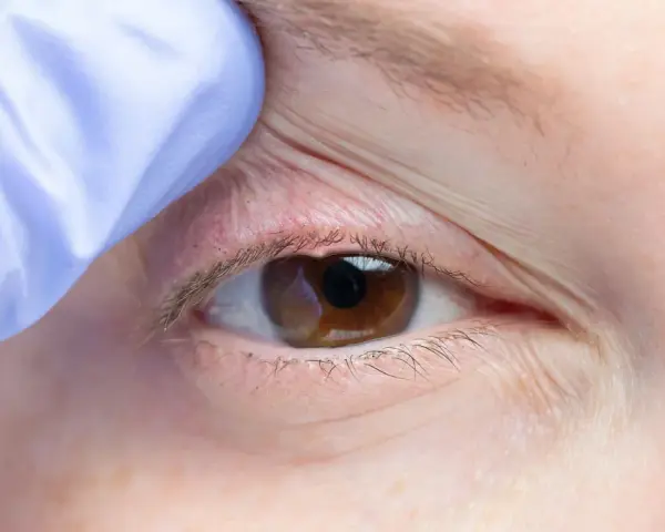 Occhio con palpebra sollevata da guanto blu, evidenziando arrossamento e possibili ghiandole di meibomio ostruite, cause di disagio.