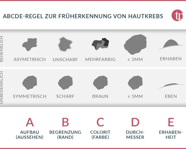 ABCDE-Regel zur Früherkennung von Hautkrebs: Asymmetrie, Begrenzung, Colorit, Durchmesser, Erhabenheit. Hilft, Hautkrebs frühzeitig zu erkennen.