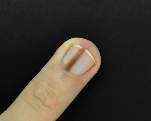 Un ongle de doigt présente une ligne verticale brune, un signe possible de carence en fer.