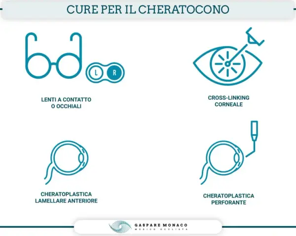 Illustrazione delle cure per il cheratocono: lenti, cross-linking, cheratoplastica lamellare e perforante. Queste opzioni aiutano a gestire le conseguenze del cheratocono.