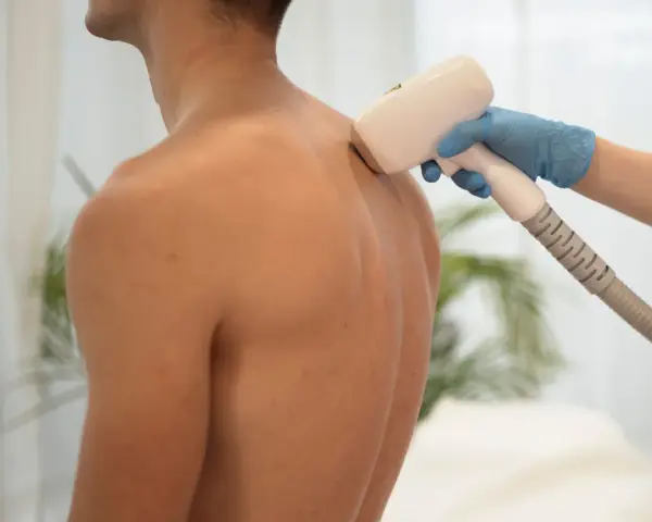Zabieg depilacji laserowej pleców u mężczyzny. Włosy na plecach u mężczyzn przyczyny mogą być różne, ale nowoczesne metody pozwalają na trwałe ich usunięcie.