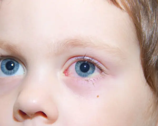 Occhio di bambino con congiuntivite, l'occhio rosso e irritato, con piccole vene visibili.