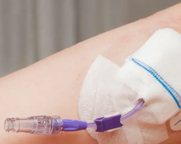 Cewnik do żywienia pozajelitowego podłączony do ręki. Zapewnia niezbędne składniki odżywcze, gdy tradycyjne żywienie jest niemożliwe.