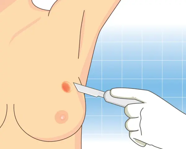Ilustracja przedstawia biopsję piersi, gdzie skalpel zbliża się do zmiany na skórze.