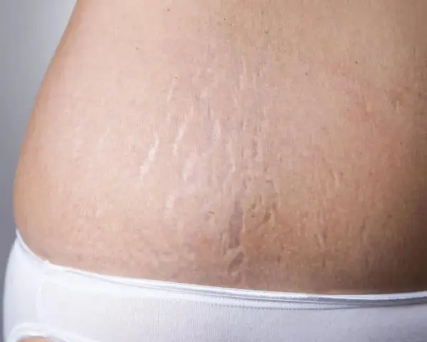 Widoczne rozstępy na brzuchu, które można zredukować zabiegiem dermapen.