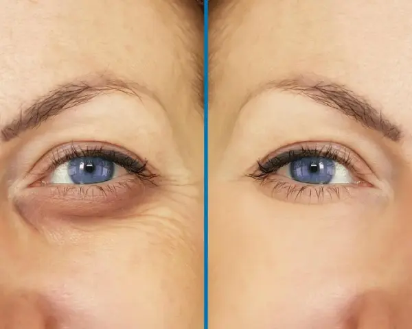 Antes y después de un tratamiento para ojeras y arrugas. Los ojos hundidos se ven más luminosos y la piel más tersa.
