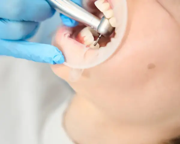 Co dentysta wkłada w zębodół po ekstrakcji? Wszystko, co musisz wiedzieć