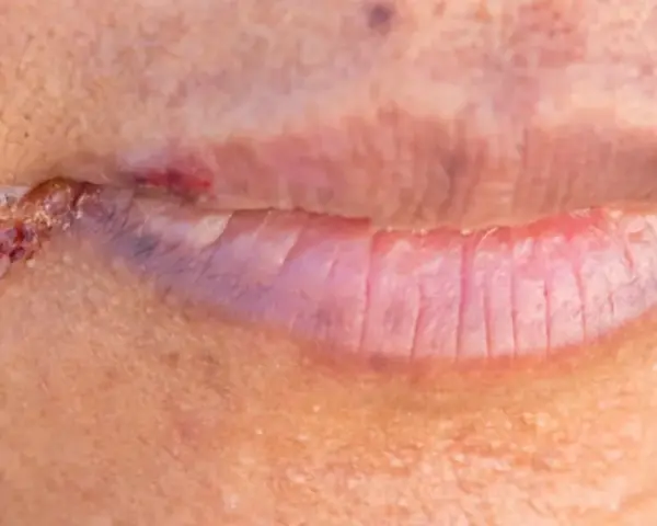 Czy z zajadami można iść do dentysty? Ważne informacje i porady