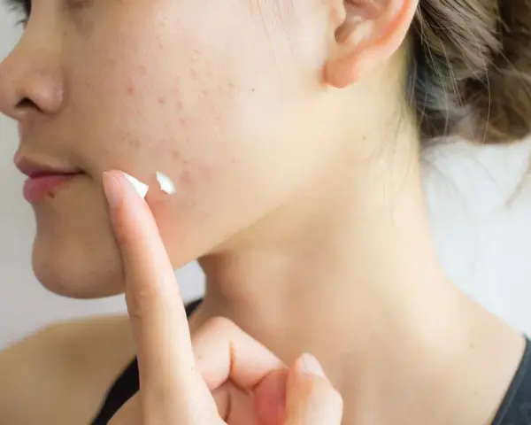 Pasta do zębów na pryszcze? Dermatolodzy: To mit i szkoda dla skóry