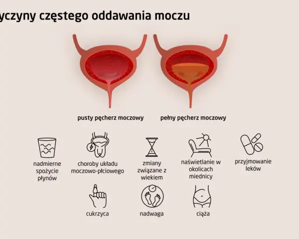 Ilustracja pokazuje przyczyny częstego oddawania moczu: nadmierne picie, choroby układu moczowo-płciowego, wiek, naświetlanie, leki, cukrzyca, nadwaga, ciąża.