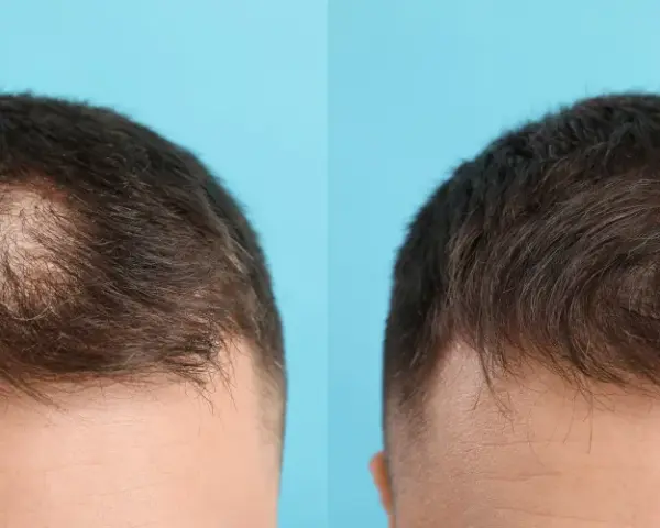 Före och efter bilder som visar resultat av microneedling hårbotten. Håret ser tätare ut efter behandlingen.