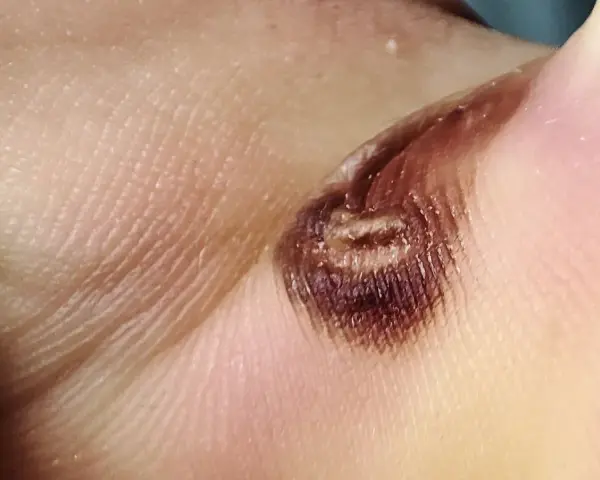 Nahaufnahme einer verbrannten Hautstelle, die wie eine Wasserblase aussieht. Die Behandlung dieser Verletzung ist wichtig.