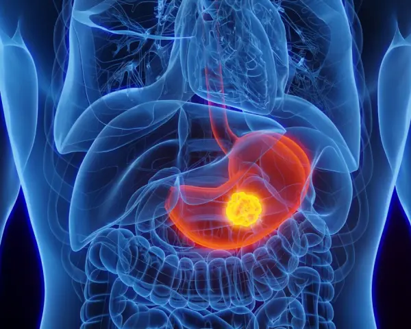 Anatomische Darstellung des menschlichen Oberkörpers mit hervorgehobenem Magen. Ein leuchtend gelber Tumor im Magen könnte ein Anzeichen für Magenkrebs sein.