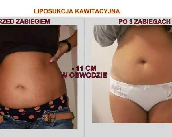 Co lepsze: lipolaser czy liposukcja kawitacyjna? Porównanie skuteczności