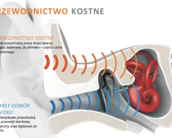 Ilustracja porównuje przewodnictwo kostne (drgania przez kości twarzy do ślimaka) ze zwykłym odbiorem dźwięku.