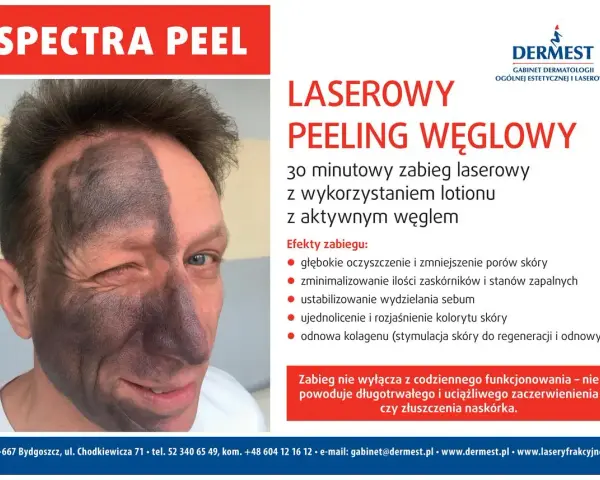 Przed i po laserowym peelingu węglowym: połowa twarzy pokryta czarną maską węglową, druga połowa czysta. Efekt odświeżenia i oczyszczenia.