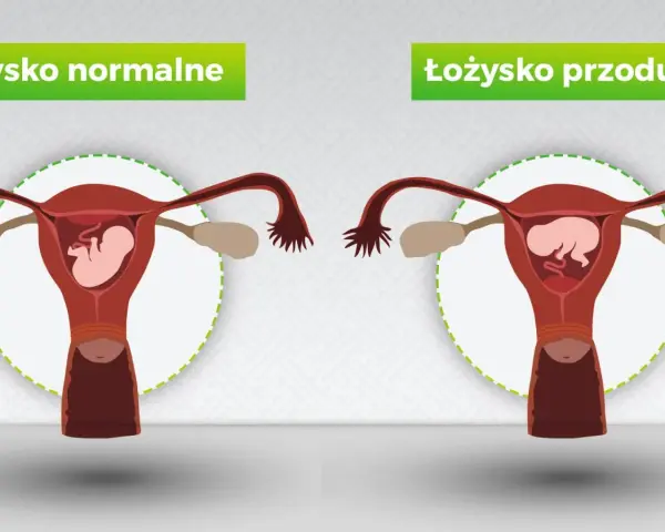 Porównanie: łożysko normalne vs łożysko przodujące. Na obrazku widać macicę z płodem. W przypadku łożyska przodującego, łożysko znajduje się na przedniej ścianie macicy.