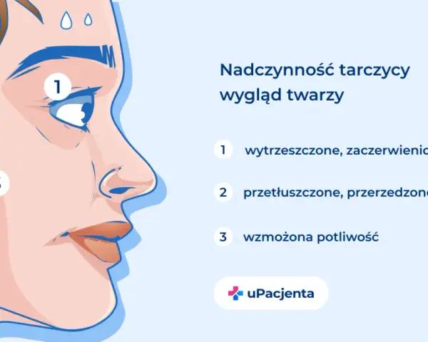 Nadczynność tarczycy objawia się wytrzeszczem oczu (1), przetłuszczonymi włosami (2) i wzmożoną potliwością (3).