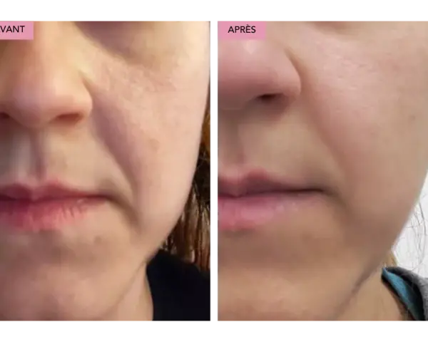 Comparaison avant/après : la peau semble plus lisse et les rides d'expression moins marquées grâce au bakuchiol.