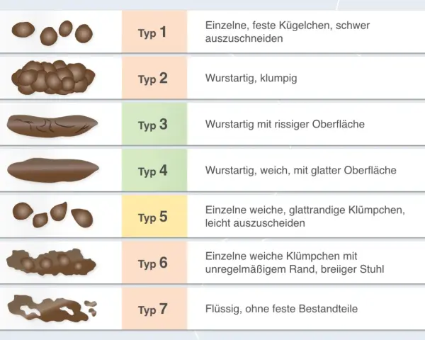 Typ 6 zeigt einzelne weiche Klümpchen mit unregelmäßigem Rand, was auf breiigen Stuhlgang hindeutet. Die Abbildung vergleicht verschiedene Stuhlformen.