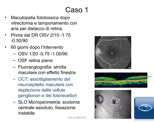 Caso 1: Maculopatia post-vitrectomia con bolla d'aria. Immagini OCT e SLO mostrano assottigliamento neuroepiteliale e scotoma.