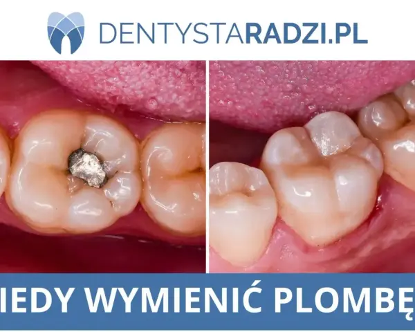 Porównanie zęba przed i po plombowaniu. Widoczny ubytek wypełniony amalgamatem i zdrowy ząb po zabiegu.