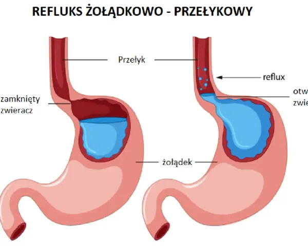 Ilustracja pokazuje refluks żołądkowo-przełykowy. Po lewej zamknięty zwieracz, po prawej otwarty, powodujący cofanie się treści żołądkowej do przełyku. Kawa może nasilać ten problem.