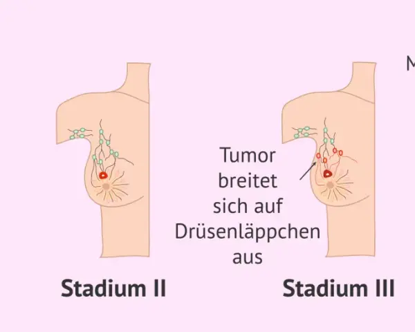 Illustrationen zeigen Stadien von Brustkrebs. Frühe Symptome wie ein Tumor werden sichtbar, bevor er sich ausbreitet. Spätere Stadien zeigen Metastasen.